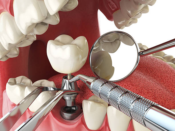Best Emergency Dental Services for Seniors in Naples, FL